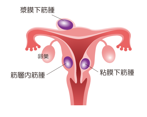 神戸アドベンチスト病院 | 子宮筋腫